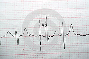 ECG ElectroCardioGraph paper that shows Normal Sinus Rhythm NSR with frequent PACs Premature Atrial Contractions, PVCs Premature photo