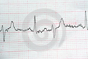 ECG ElectroCardioGraph paper that shows Normal Sinus Rhythm NSR with frequent PACs Premature Atrial Contractions, PVCs Premature photo