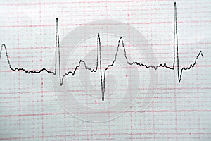 ECG ElectroCardioGraph paper that shows Normal Sinus Rhythm NSR with frequent PACs Premature Atrial Contractions, PVCs Premature photo