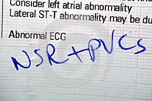 ECG ElectroCardioGraph paper that shows Normal Sinus Rhythm NSR with frequent PACs Premature Atrial Contractions, PVCs Premature photo