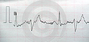 ECG ElectroCardioGraph paper that shows Normal Sinus Rhythm NSR with frequent PACs Premature Atrial Contractions, PVCs Premature photo