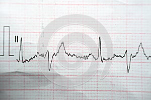 ECG ElectroCardioGraph paper that shows Normal Sinus Rhythm NSR with frequent PACs Premature Atrial Contractions, PVCs Premature photo