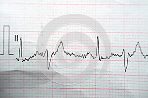 ECG ElectroCardioGraph paper that shows Normal Sinus Rhythm NSR with frequent PACs Premature Atrial Contractions, PVCs Premature