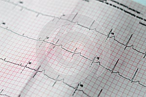 ECG ElectroCardioGraph paper that shows sinus rhythm abnormality of right ventricular hypertrophy, inferior T wave due to