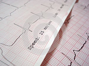 ECG electrocardiography