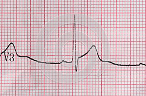 ECG Electrocardiography