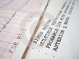 ECG electrocardiography diagram