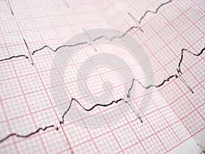 ECG electrocardiography diagram