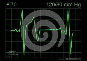 ECG graph