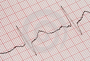 ECG graph