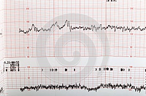 Ecg graph