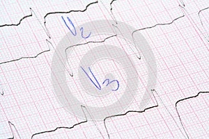 ECG graph with doctor notes