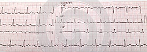 Ecg graph, electrocardiogram ekg