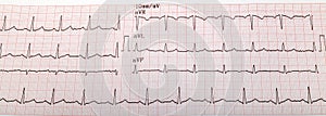 Ecg graph, electrocardiogram ekg photo