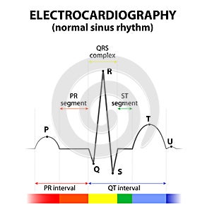 ECG of a heart in normal sinus rhythm