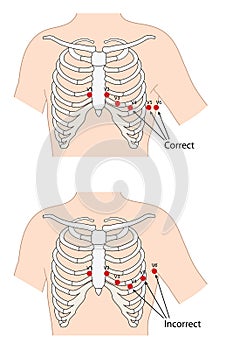 Ecg lead placement