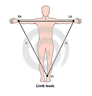 ECG limb leads photo