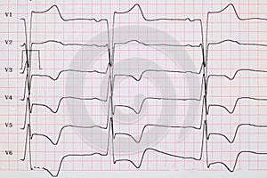 ECG. Myocardial infarction on ECG, subendocardial ischemia in chest leads. Angina. Chest pain. Close-up.