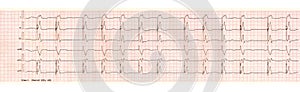 ECG with pacemaker arrhythmia ventricular stimulation