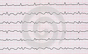 ECG with paroxysm correct form of atrial flutter with atrioventricular conduction 2:1