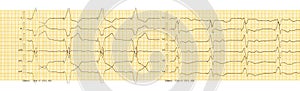 ECG with rhythm of artificial pacemaker ventricular stimulation