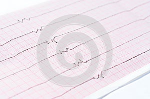 ECG with single ventricular complexes and and ventricular asystole