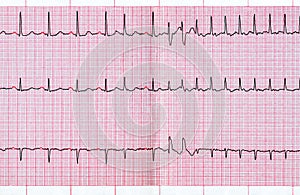 ECG with supraventricular extrasystole and short paroxysm of atrial fibrillation