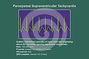 ECG in supraventricular tachycardia, 3D illustration