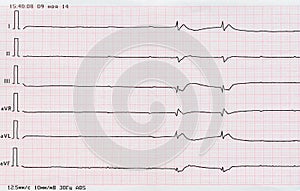 ECG tape (dying heart)