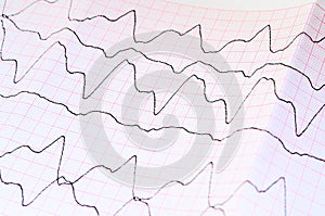 ECG tape with paroxysmal ventricular tachycardia