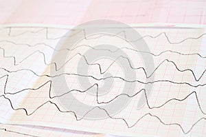 ECG tape with paroxysmal ventricular tachycardia