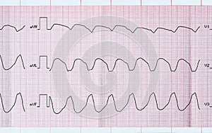 ECG tape with paroxysmal ventricular tachycardia