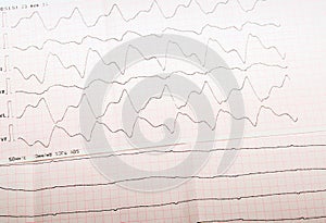 ECG tape with paroxysmal ventricular tachycardia and ventricular