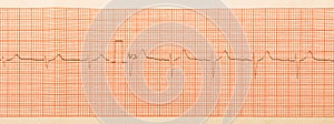 ECG test results on millimeter paper, heart rhythm results