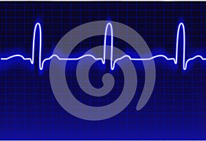 ECG trace