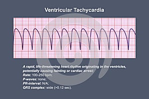 ECG in ventricular tachycardia, 3D illustration.