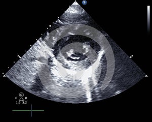 Echocardiogram