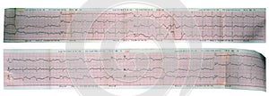 Echocardiogram ( ECG, EKG ) heart reading