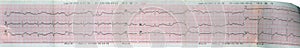Echocardiogram ( ECG, EKG ) heart reading