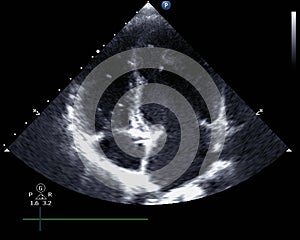 Echocardiogram