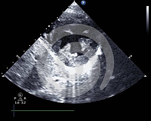 Echocardiogram