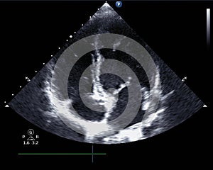 Echocardiogram