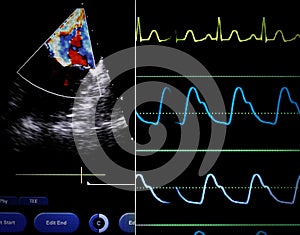 Echocardiographic parameters synchronized with ECG. Screen of a