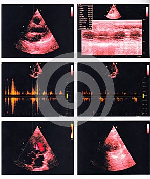 An echocardiography report of a male patient.