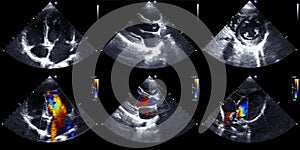 Echocardiography photo