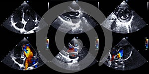 Echocardiography