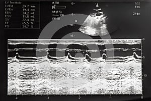 Echocardiography, ultrasound of the heart. Normal children`s result of a medical research method.