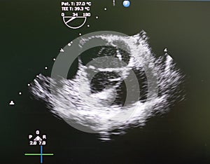 Echocardiography ultrasound machine.2D aortic valve Echocardiography ultrasound machine.