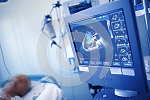 EchoCG exam of comatose patient on the display in the ICU