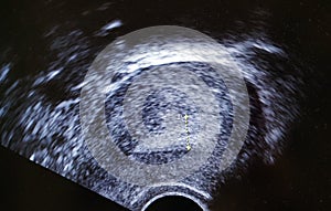 Ecography ultrasound endometrial layer photo